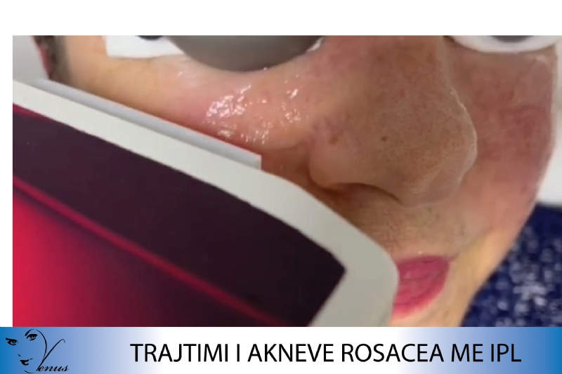 Klinika Venus, Mesoterapi per syte, Mesoterapi per fytyren, Mesoterapi per qafen, Mesoterapi e flokeve, Plazem PRP, PRP + Dermapen, Jonoforeze per trajtimin e djerses se shtuar, Radiofrekuence, Dermatoskopi, UVB-N-Band, 